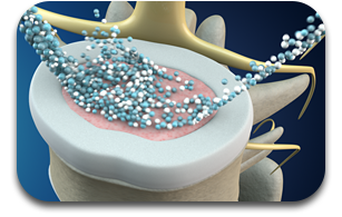 Spinal Decompression Explained