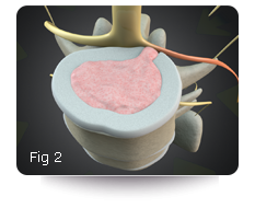 Herniated Disc Treatment Figure 2