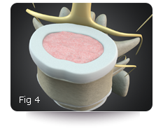 Herniated Disc Treatment Figure 4