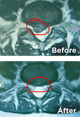 Herniated Disc x-ray